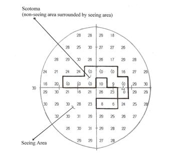 Printout showing scotoma with non-seeing area surrounded by
 seeing area